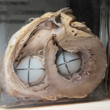 April 1, 2023. Belarus, Minsk. Exhibition of an anatomical exhibit of the human heart in the section with an artificial valve Exhibits of the Museum of Anthropology and Ethnography.