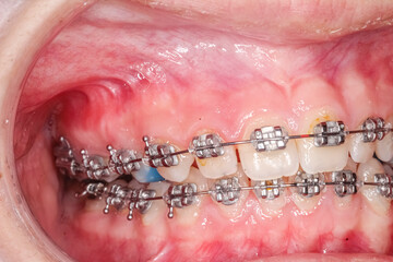 Lateral oblique view of dental arches in biting teeth occlusion with molar bite-raising blue resin...