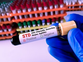 Biochemist or Lab Technologist holds Blood sample for STD or Sexually Transmitted Disease Test with...