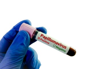 Obraz premium Doctor or lab technician holding blood sample for HPV VIRUS (Human Papillomavirus) test.