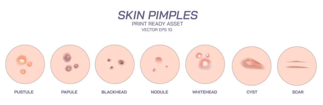 Skin Pimples and acne vector illustration. Appearance of the different pimples of human skin. blackheads, whiteheads, papule, pustule, cystic, nodule, scar. Print ready vector file.