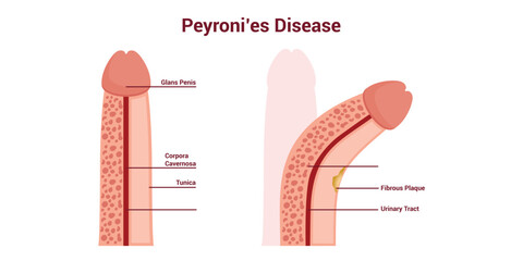 Peyronie's Disease Medical Vector Illustration © tru3_Art