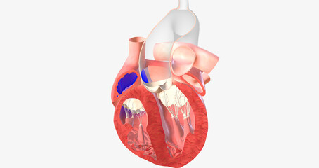 Normal blood flow in the heart