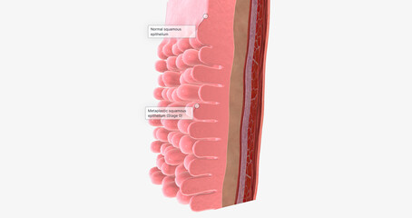 Adenocarcinoma of the esophagus results from abnormal cell mutations and growth in the esophageal lining, or mucosa.
