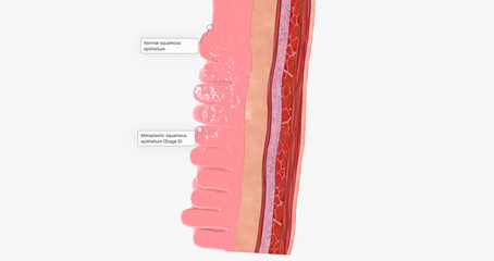 Adenocarcinoma of the esophagus results from abnormal cell mutations and growth in the esophageal lining, or mucosa.