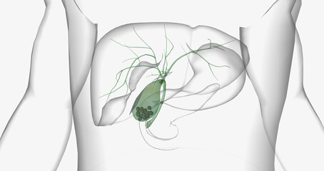 Gallstones are pieces of solid material that form in the gallbladder, a small hollow organ located beneath the liver.