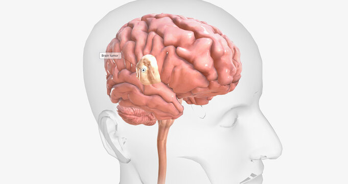 Brain tumors are abnormal growths found in brain tissue. Brain tumors may be benign or malignant.