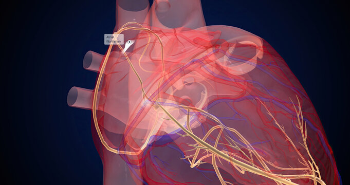 Atrial fibrillation is a type of abnormal heartbeat that affects the atria (upper chambers) of the heart.