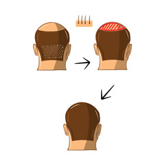 Vector Illustrated set with hair transplant surgery. Infographics with icons of plastic surgery procedures.