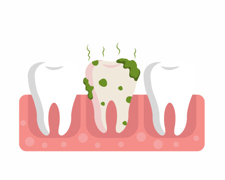 Dirty and bad breath teeth Bacteria between teeth concept of oral hygiene and healthcare.