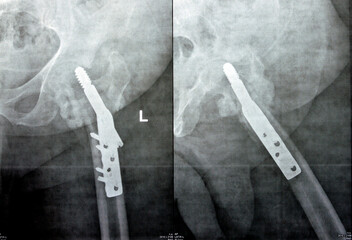 Left hip trans cervical neck of femur fracture fixated by DHS Dynamic Hip Screw, Plain x ray PXR of...