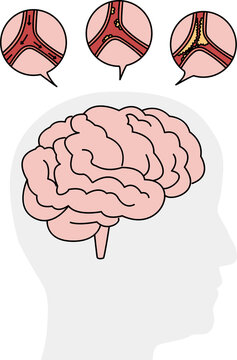 Medical illustration of human brain stroke