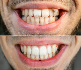 Close up teeth man. Before and after treatment teeth alignment, braces banner