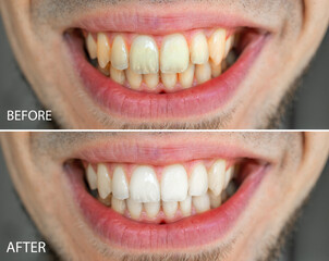 Close up portrait smile teeth man. Before and after teeth whitening, Dental care concept