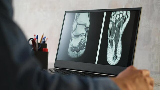 The doctor examines an x-ray or mri image of the patient's ankle joint on the monitor