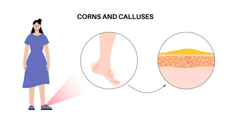 Callus and corns