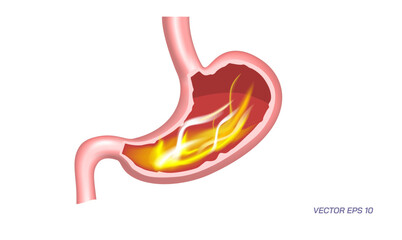 Fototapeta premium Human stomach problems, Gastrointestinal diseases. Common Digestive Disorders. Poor Digestive conditions. How right medication keep your stomach healthy. Student biology study material images.