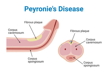 Peyronie's Disease Medical Vector Illustration - obrazy, fototapety, plakaty
