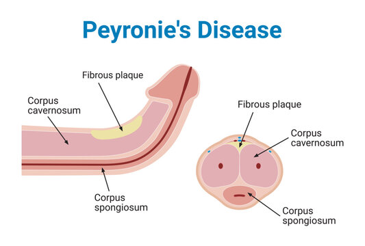 Peyronie's Disease Medical Vector Illustration