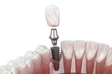 Tooth recovery with implant. 3D illustration with transparent background - 607293325