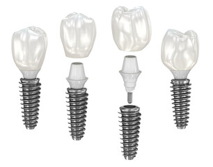 Dental implant and ceramic crown. Medically accurate 3D illustration with transparent background