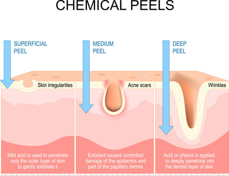 Chemical peels. Exfoliation