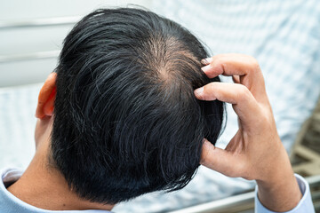 Fototapeta premium Bald in the middle head and begin no loss hair glabrous of mature Asian business smart active office man.