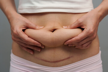 woman grabs and pinches her postpartum belly fat and c-section scar of caesarean