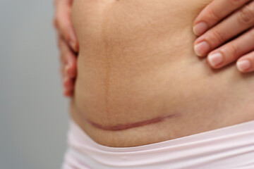 close up belly of woman with c-section scar of caesarean