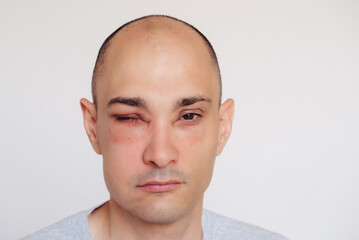 Caucasian man has angioedema around the eyes caused by allergic reaction to agents such as insect...