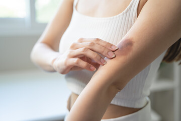 woman get injured and have bruised on her arm.
