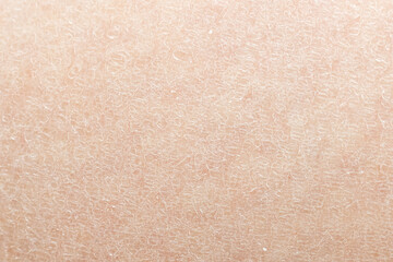 Macro dry skin (fish scales) details. Dermatology and skincare concept with a macro view of a...
