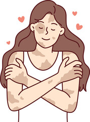 Positive girl with vitiligo disease hugging herself taking skin diseases as personal feature