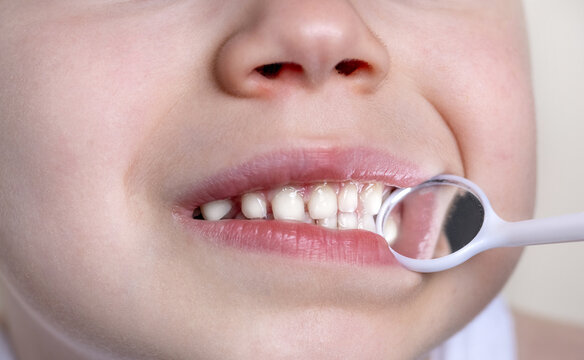 Smiling Kid Boy Preschooler Child At Dentist.smiling Happy Baby With Diastema, Gaps Between Teeth.mouth Mirror And Explorer Scaler Tools In Front Of Face.wide Open Mouth Healthy Milk Teeth Tooth.daily