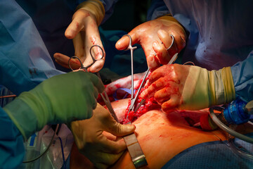 Surgical operation, closeup on operating field and hands of surgeons