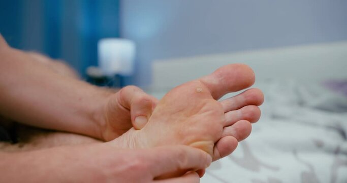 Wart verrucas plantar, self inspection man at home. Decease on foot skin. Close-up shot