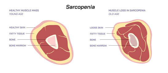 Loss of muscle mass and strength Sarcopenia vector illustration. Difference between Young age muscle mass and Old age muscle mass.  - obrazy, fototapety, plakaty