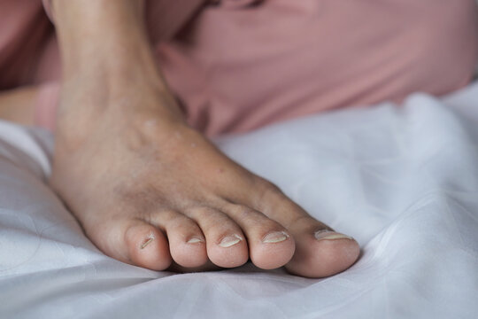 close up of women feet with swelling 