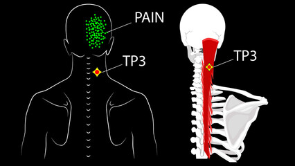 Semispinalis muscles. Trigger points and referred pain on the back of the head