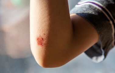 close-up of big dry sore on arm of child, the wound heals