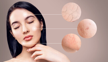 Magnifying circles shows skin problems of young woman.