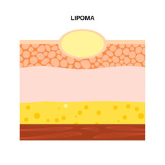 Lipoma medical poster