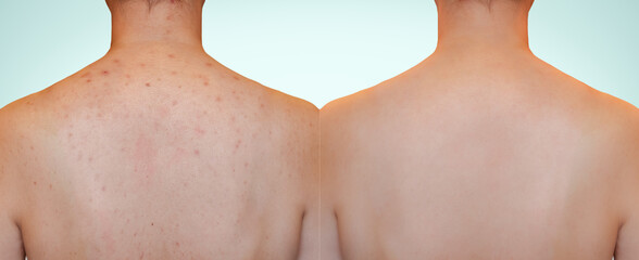 Closeup young woman's back with red rash skin and acne scar on especially on shoulder. Image...