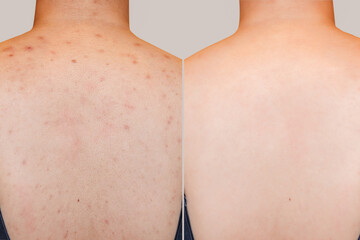 Closeup young woman's back with red rash skin and acne scar on especially on shoulder. Image...