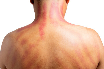 The red mark on the man's back was caused by Gua Sha. Gua sha is a natural alternative therapy to...