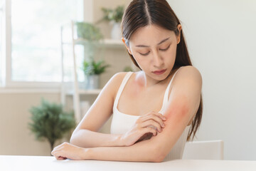 Sensitive skin allergic concept, Woman itching on her arm have a red rash from allergy symptom and...