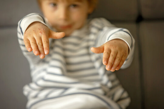 Child with skin rash, roseola. Hand-foot-and-mouth disease. Enterovirus Leg arm mouth Rash on  child. Cocksackie virus