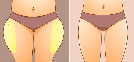 A woman's body with problem areas. Before, after. Medical infographic. Healthcare illustration. Vector illustration. - obrazy, fototapety, plakaty