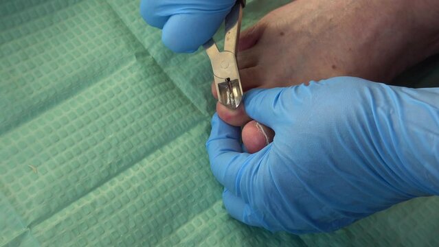Trimming the problematic nail with Onychogryphosis on the feet toe .