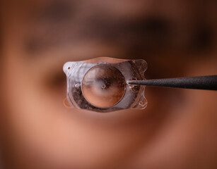 photo of Implantable Collamer Lens ICL for treating refractive errors, infront of a human eye - obrazy, fototapety, plakaty